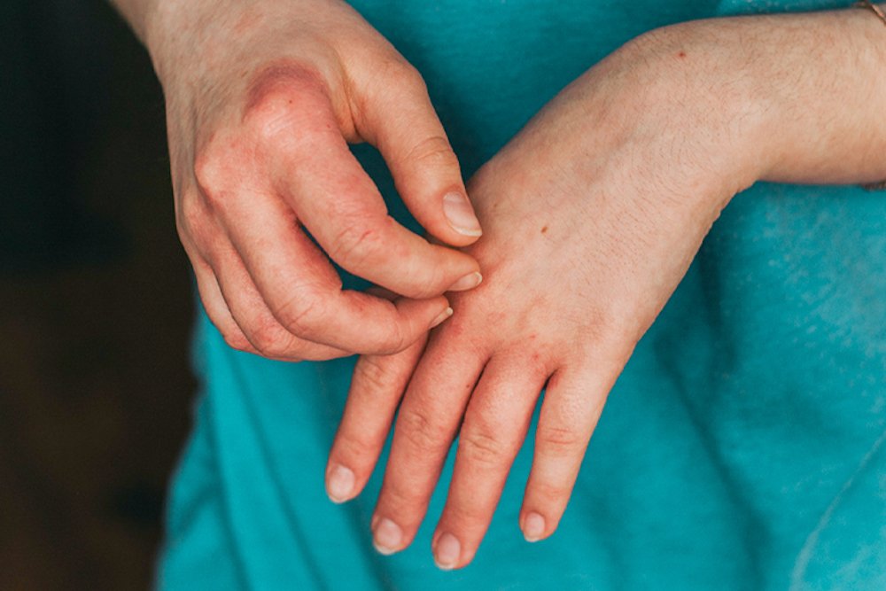 What Triggers Eczema Flare
