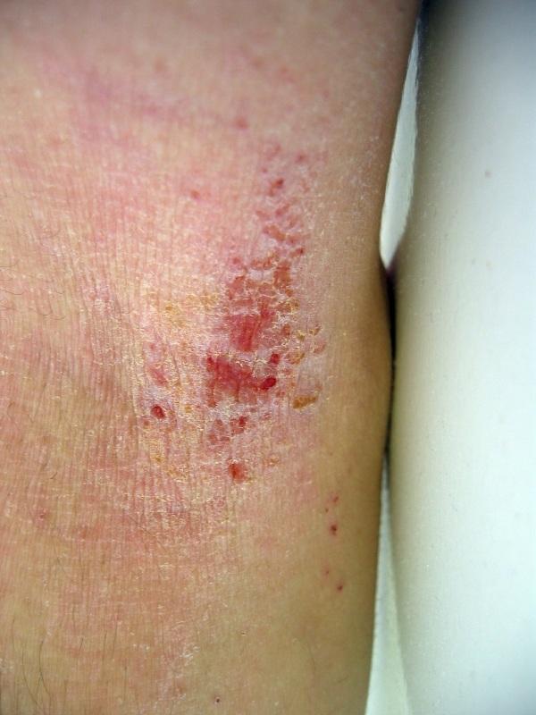 What Type Of Doctor Should I See For Acute Eczema