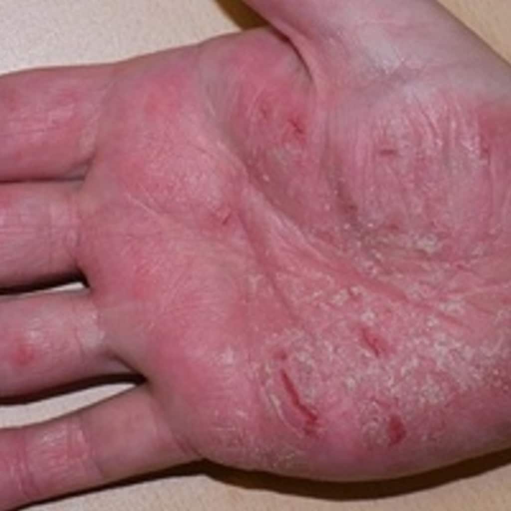 Whatâs the best treatment for hand eczema? Help researchers find out ...