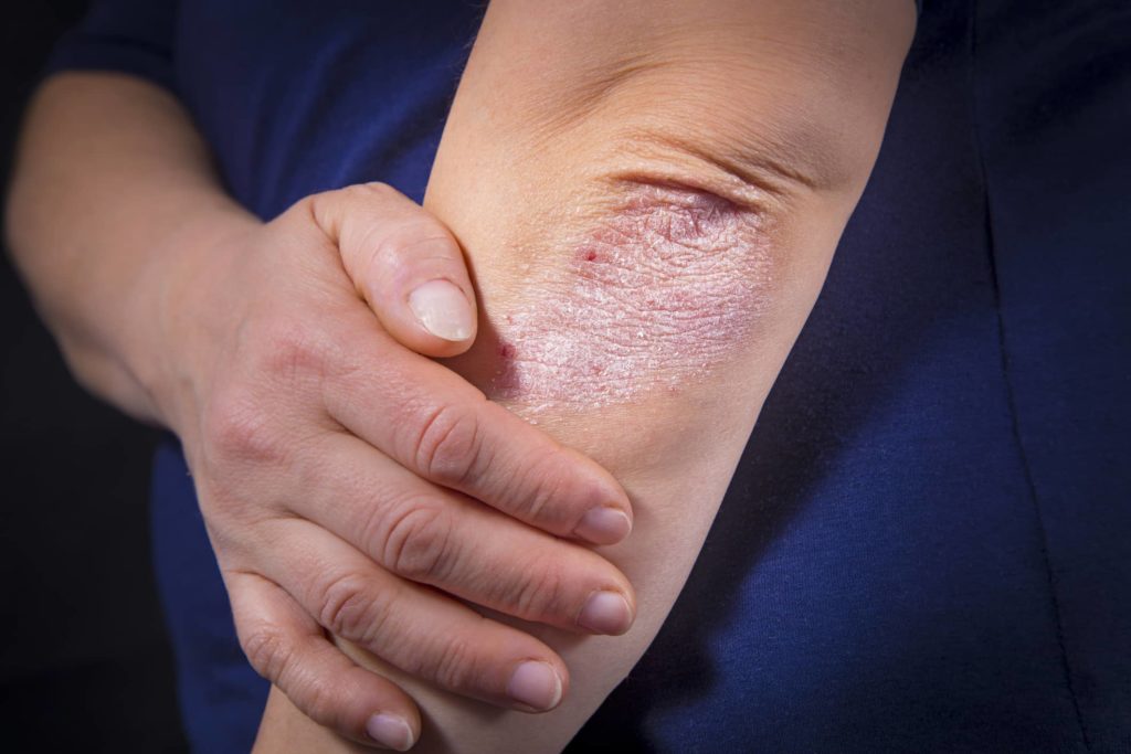 When Its More Than a Rash: How to Diagnose and Treat Eczema