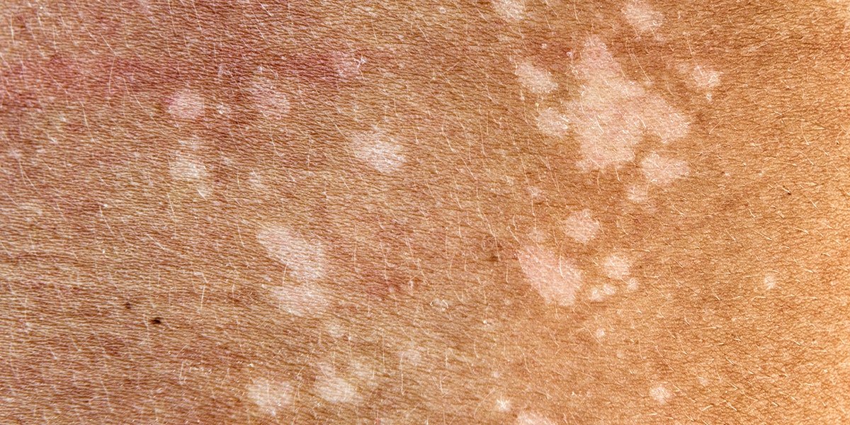 White Patch On Skin: A Cause For Concern?