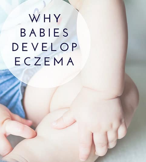 Why Babies Develop Eczema