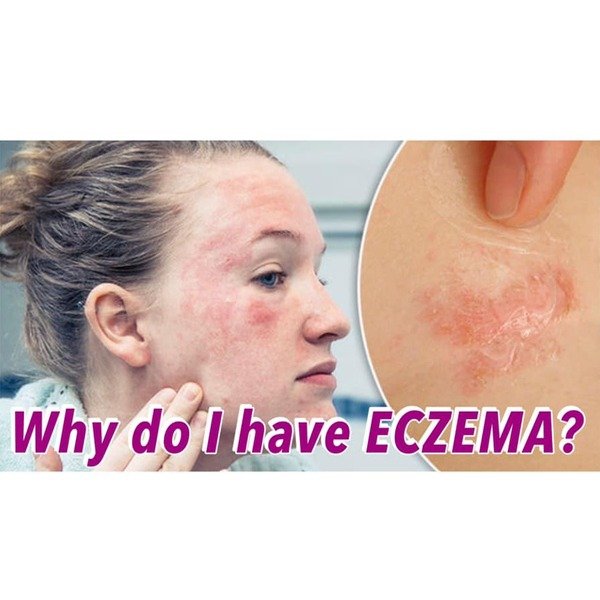 Why Do I Have Eczema?