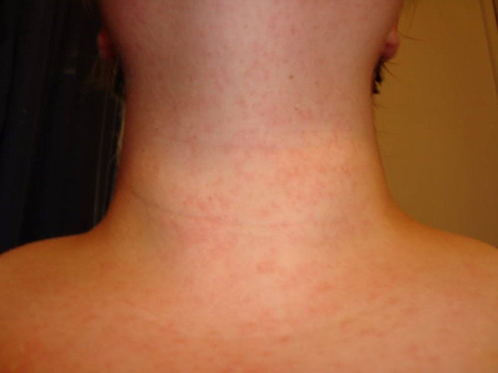 Why do i keep getting hives on my neck