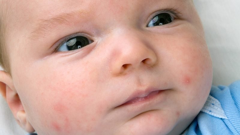 Why does My Baby and Child Develop Eczema?