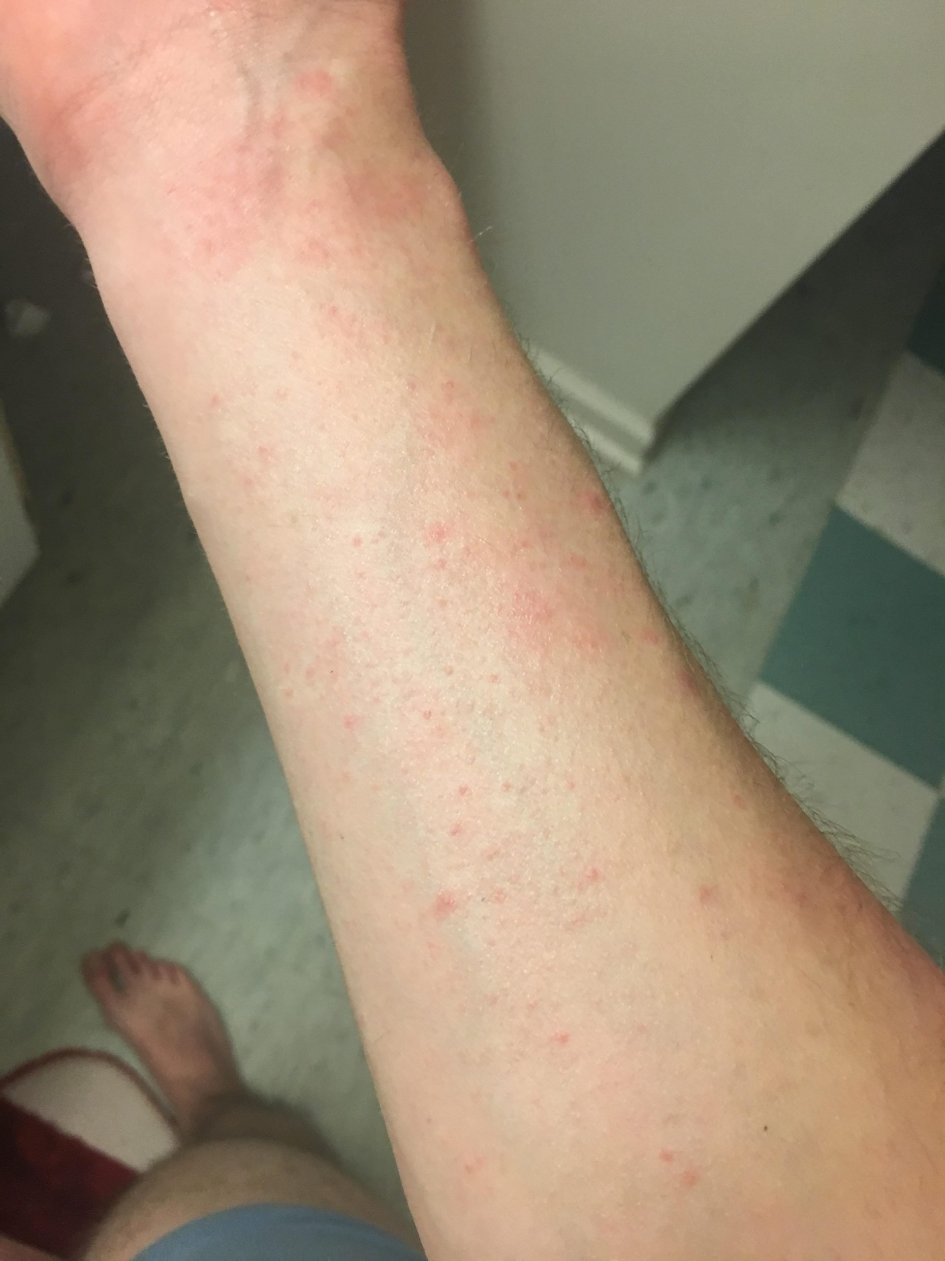 Why does my eczema suddenly look like chicken pox? : eczema