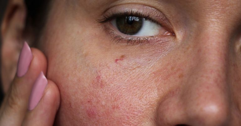 Why Is My Skin So Sensitive?