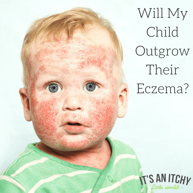 " Will your child outgrow their eczema?"  A dermatologist