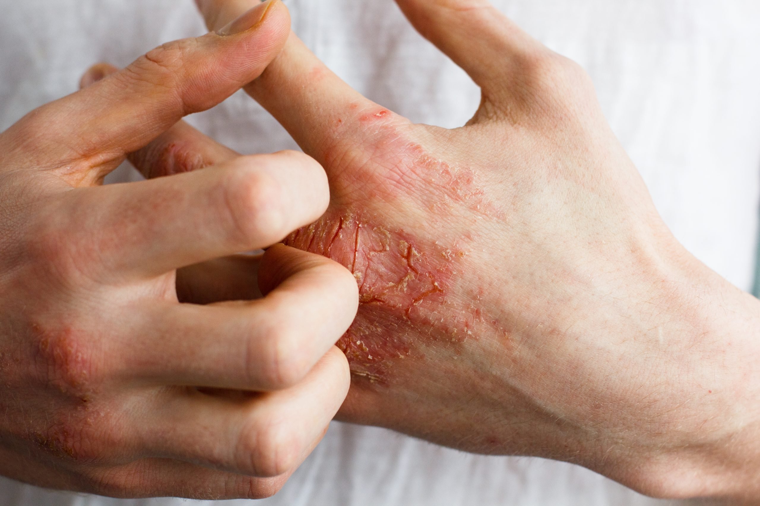 Winter Itch: Dealing With Eczema « Markham Village ...