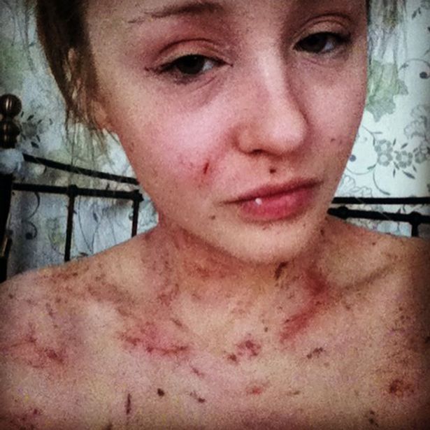 Woman covered in severe eczema which caused