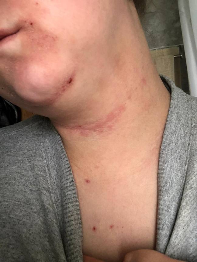 Woman Cures Painful Eczema Flare