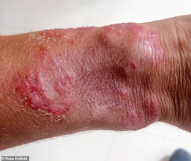 Woman finds miracle cure for excruciating eczema with donkey milk salve ...