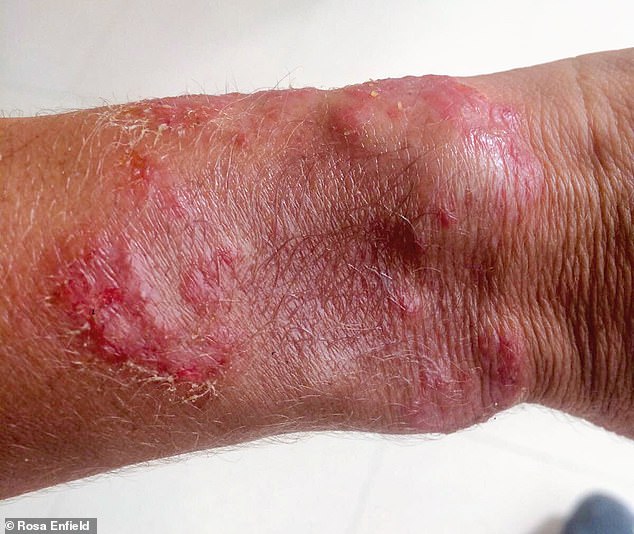Woman finds miracle cure for excruciating eczema with ...