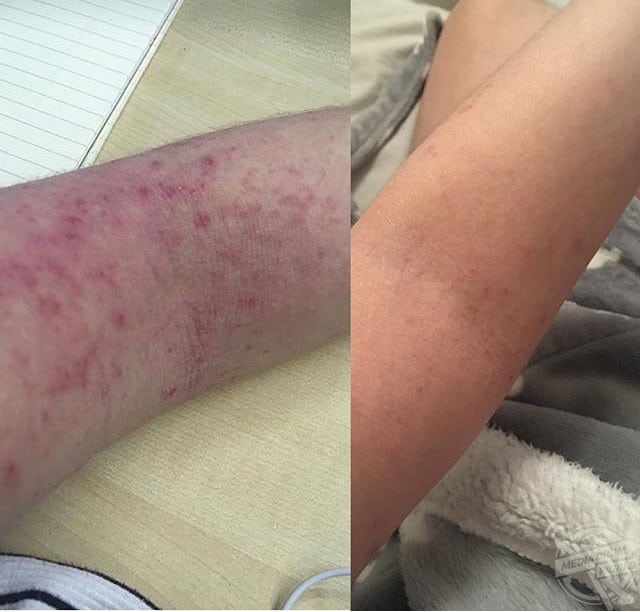 Woman Needs Cancer Drug To Fight Eczema She Was Told Only Affects ...