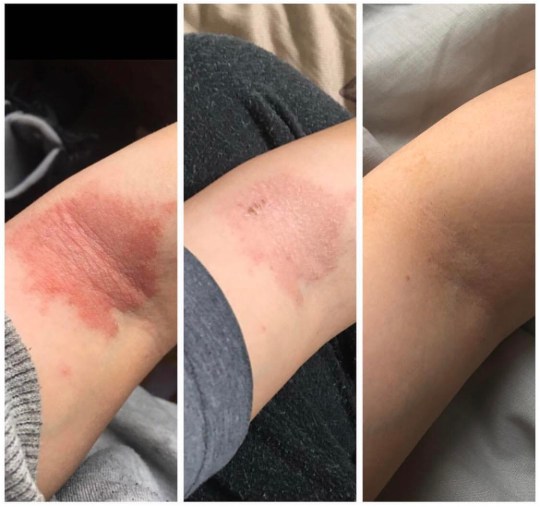Woman says she cleared her eczema by giving up coffee, eggs, milk, and ...