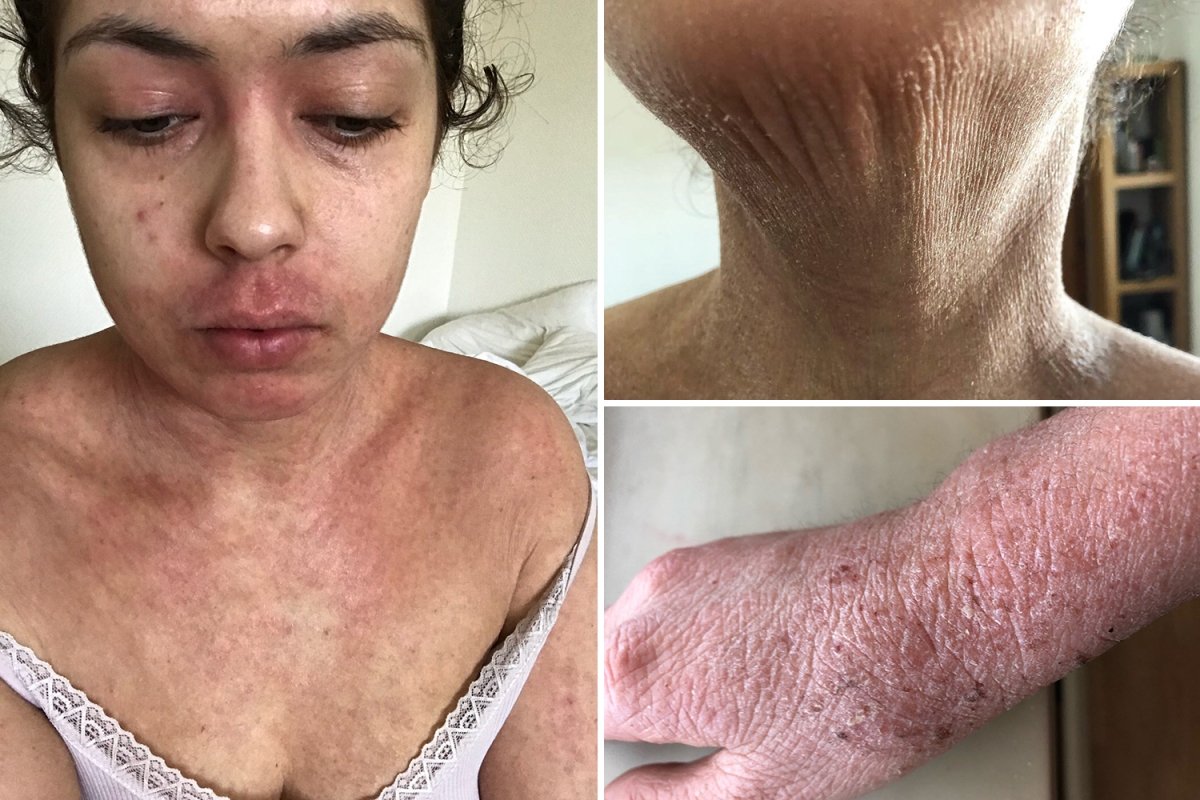 Woman whose eczema was so bad she was offered chemo is on ...
