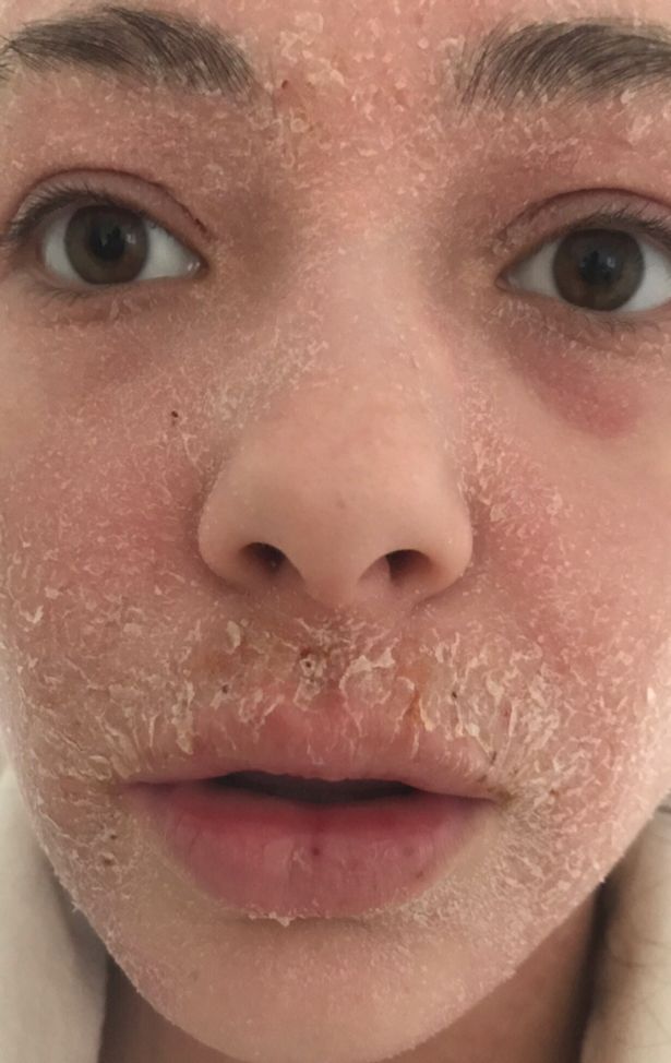 Woman whose eczema was so severe she was mistaken for ...