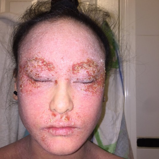 Woman with severe eczema explains why she