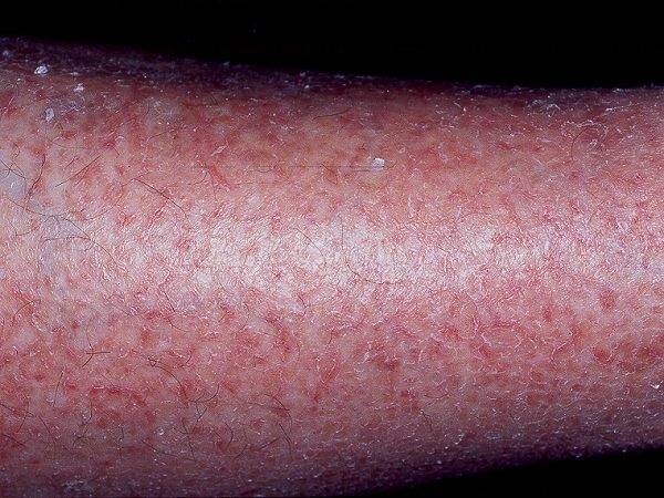 Xerotic Eczema