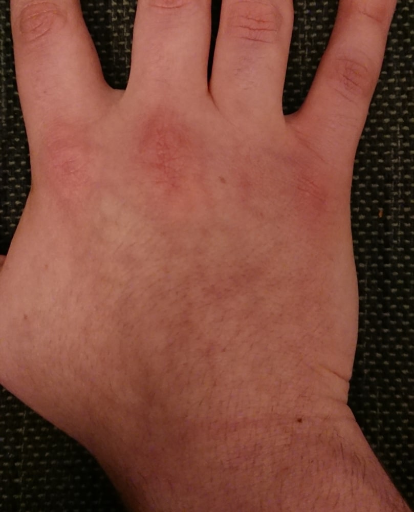 Year long rash on back of hand