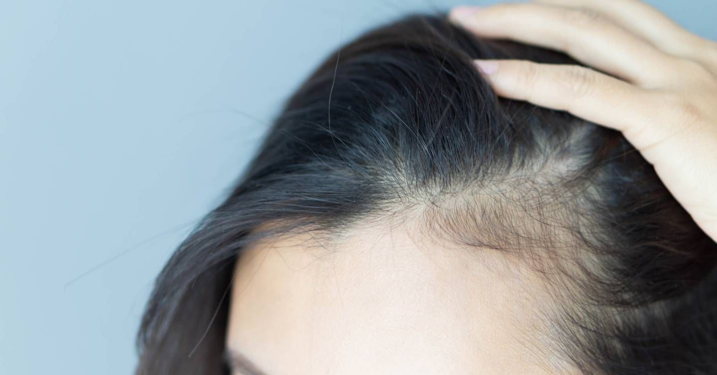 Yes, you can get eczema on your scalp and here