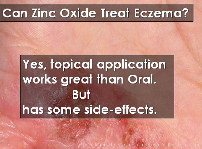 Zinc Oxide for Eczema
