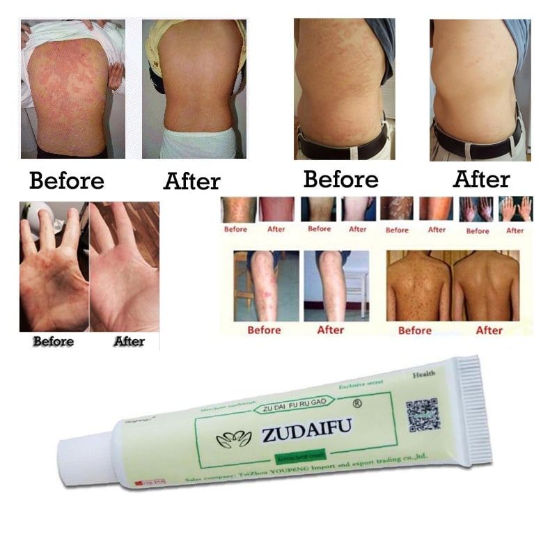 Zudaifu Skin Care Cream Skin Psoriasis Cream Dermatitis Eczematoid ...